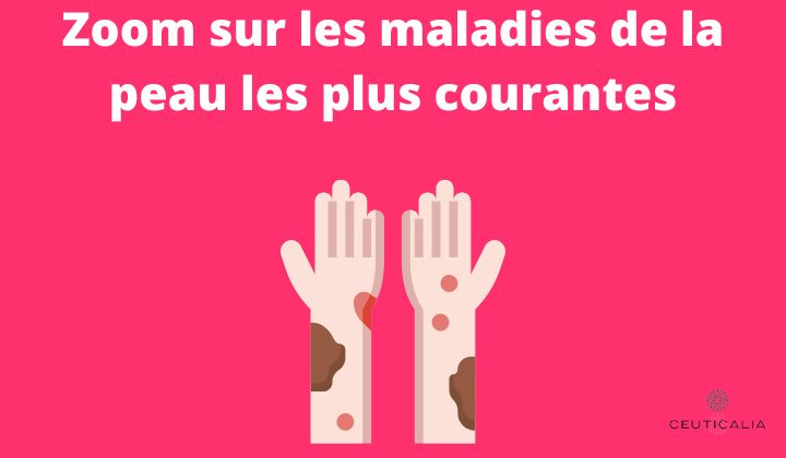 Zoom sur les maladies de la peau les plus courantes