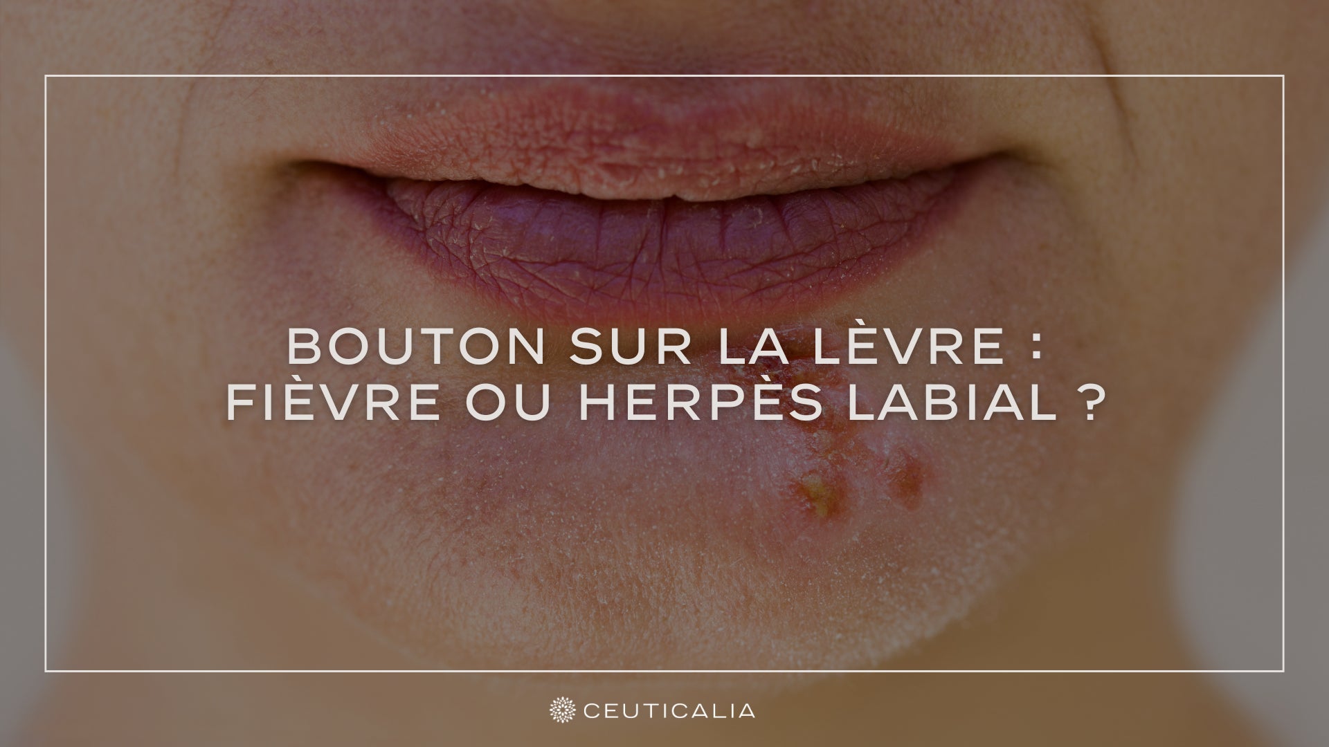 Bouton Sur La L vre Fi vre Ou Herp s Labial Ceuticalia bouton-sur-la-l-vre-fi-vre-ou-herp-s-labial-ceuticalia